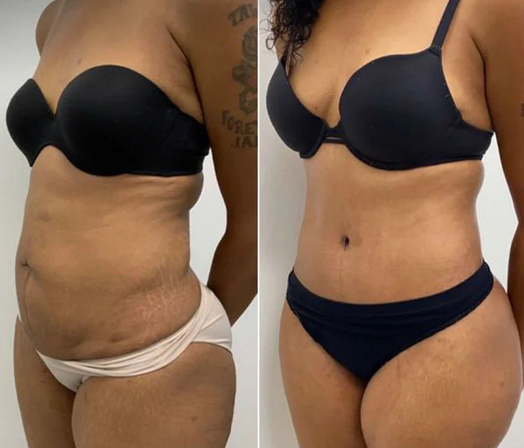 Quenzly™ – Smooth Skin in 14 Days