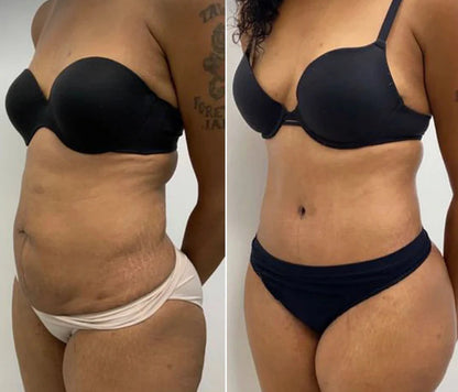 Quenzly™ – Smooth Skin in 14 Days